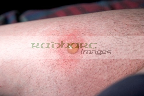 blister on mosquito bite on leg